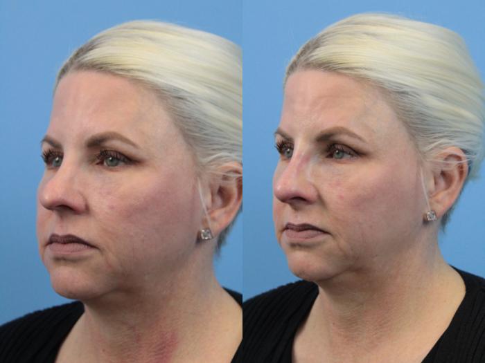 Before & After Non-Surgical Rhinoplasty Case 181 View #2 View in West Des Moines & Ames, IA