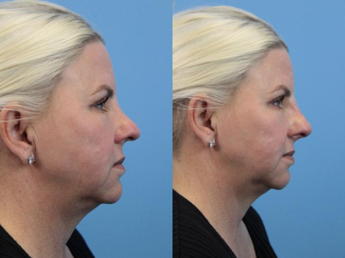 Before & After Non-Surgical Rhinoplasty Case 181 View #3 View in West Des Moines & Ames, IA