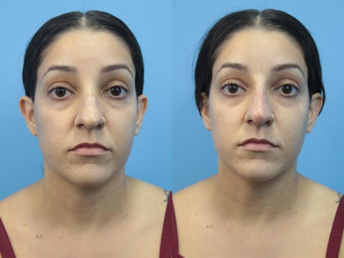 Before & After Non-Surgical Rhinoplasty Case 359 Front View in West Des Moines & Ames, IA