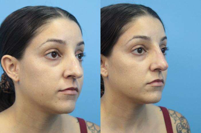 Before & After Non-Surgical Rhinoplasty Case 359 Right Oblique View in West Des Moines & Ames, IA
