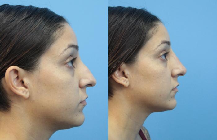 Before & After Non-Surgical Rhinoplasty Case 359 Right Side View in West Des Moines & Ames, IA