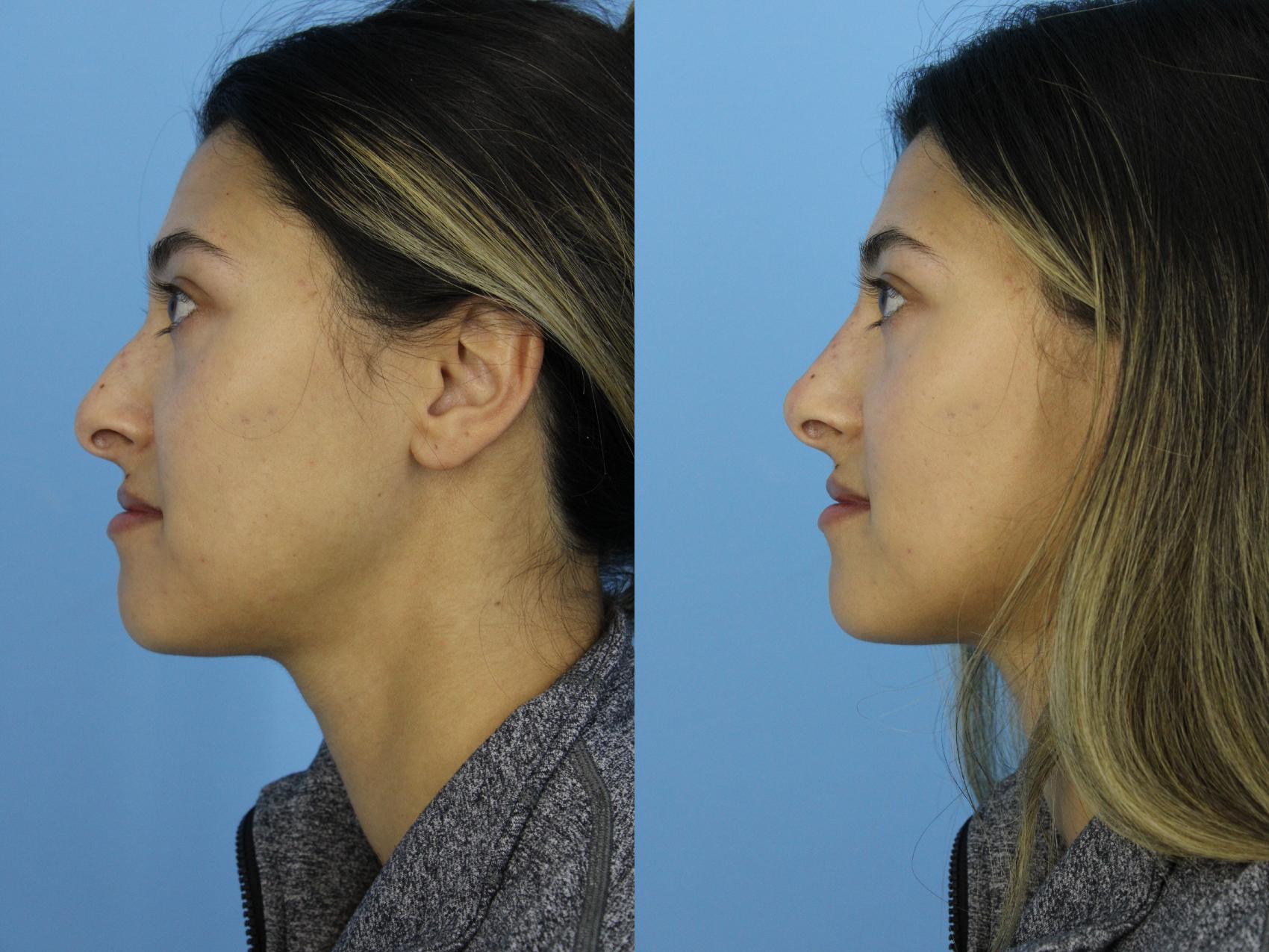 Before & After Non-Surgical Rhinoplasty Case 438 Left Side View in West Des Moines & Ames, IA