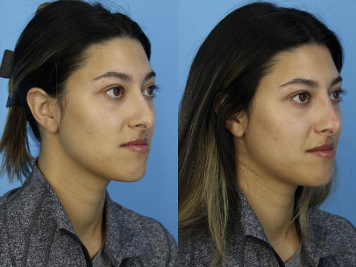 Before & After Non-Surgical Rhinoplasty Case 438 Right Oblique View in West Des Moines & Ames, IA