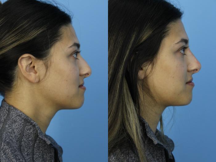 Before & After Non-Surgical Rhinoplasty Case 438 Right Side View in West Des Moines & Ames, IA