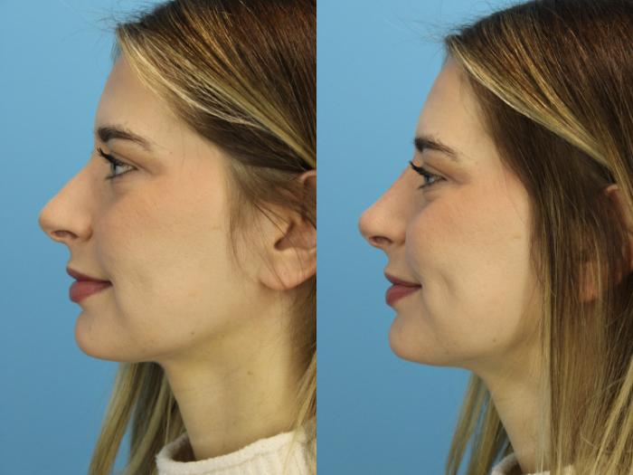 Before & After Non-Surgical Rhinoplasty Case 516 Left Side View in West Des Moines & Ames, IA