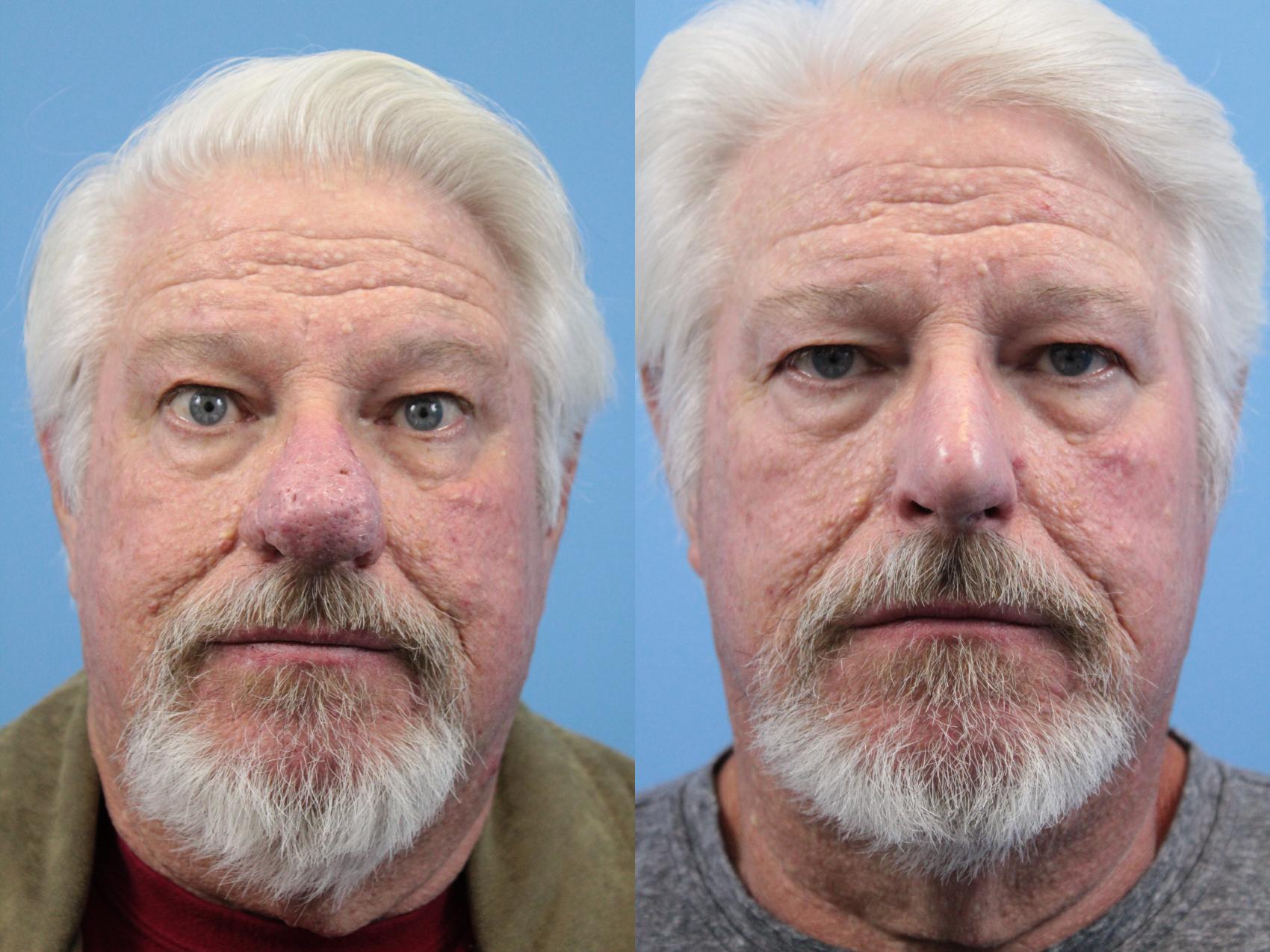 Before & After Rhinophyma Case 147 View #1 View in West Des Moines & Ames, IA