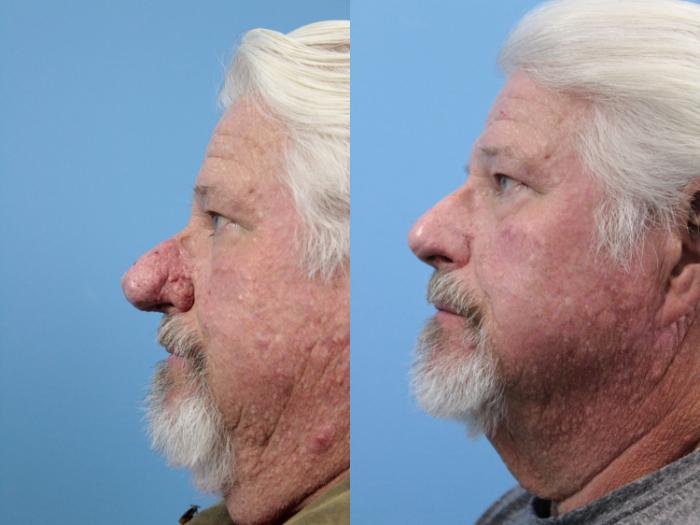 Before & After Rhinophyma Case 147 View #2 View in West Des Moines & Ames, IA