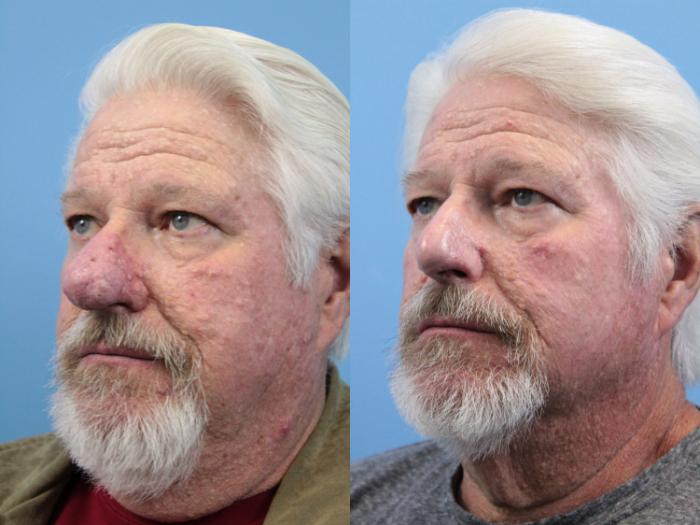 Before & After Rhinophyma Case 147 View #3 View in West Des Moines & Ames, IA