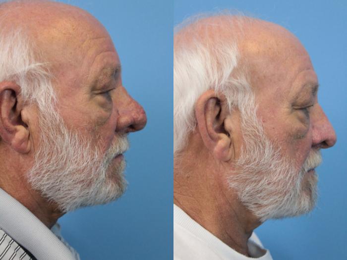 Before & After Rhinophyma Case 222 Right Side View in West Des Moines & Ames, IA