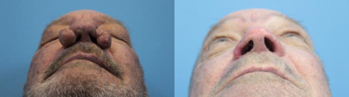 Before & After Rhinophyma Case 345 Inside nose View in West Des Moines & Ames, IA