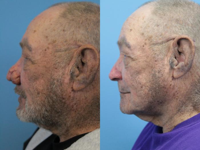 Before & After Rhinophyma Case 345 Left Side View in West Des Moines & Ames, IA