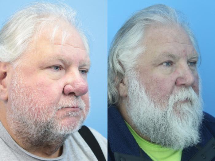 Before & After Rhinophyma Case 411 Right Oblique View in West Des Moines & Ames, IA