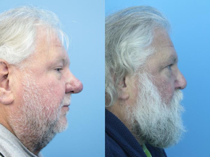 Before & After Rhinophyma Case 411 Right Side View in West Des Moines & Ames, IA