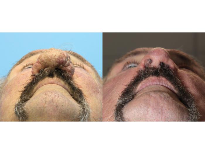 Before & After Rhinophyma Case 568 Close-Up  View in West Des Moines & Ames, IA