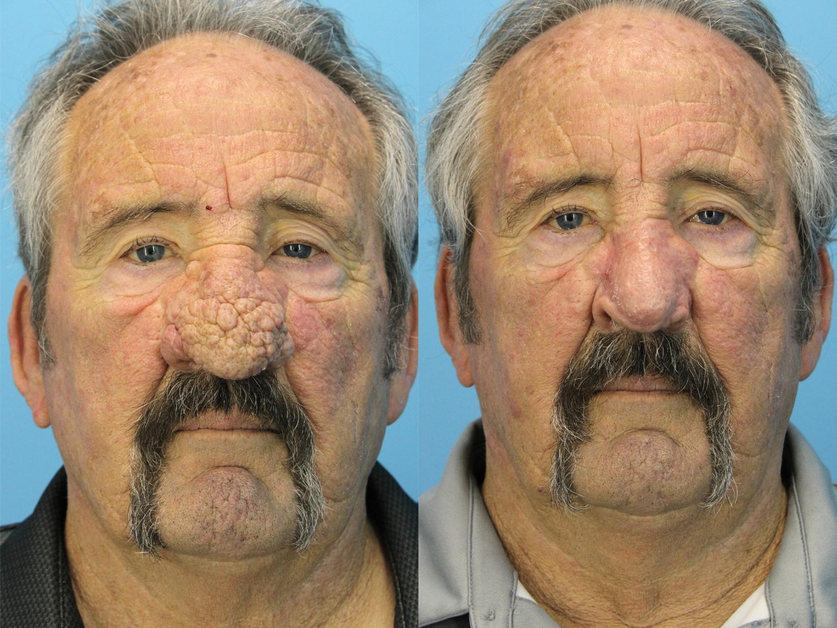 Before & After Rhinophyma Case 568 Front View in West Des Moines & Ames, IA