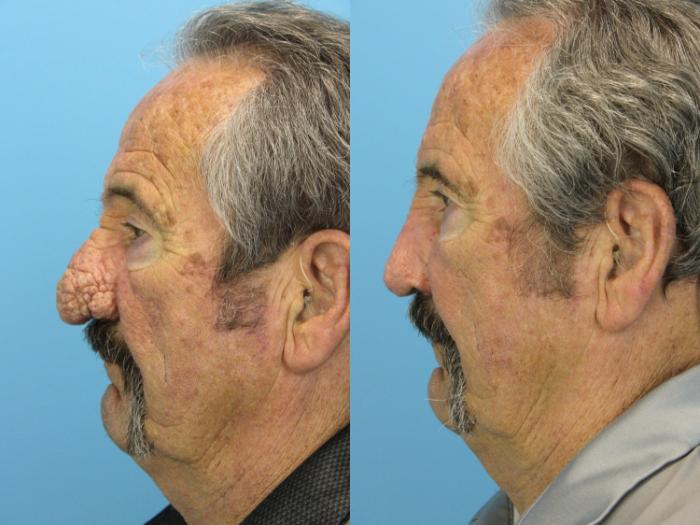 Before & After Rhinophyma Case 568 Left Side View in West Des Moines & Ames, IA