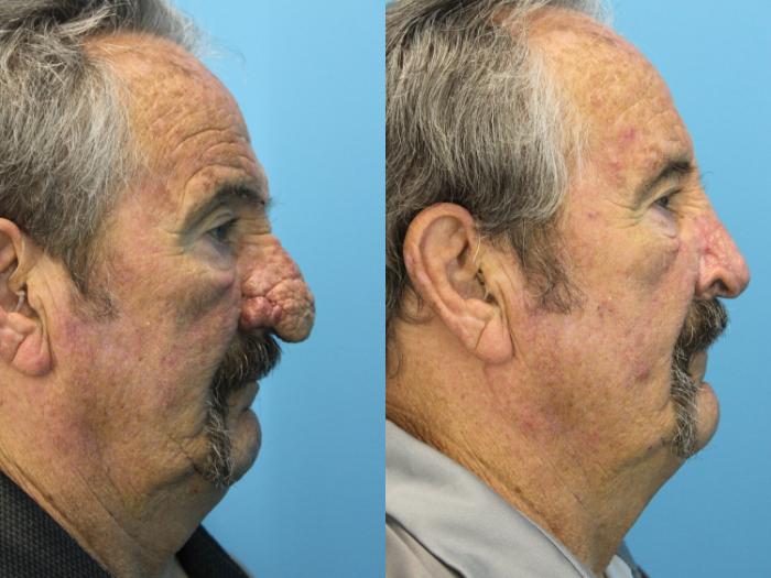 Before & After Rhinophyma Case 568 Right Side View in West Des Moines & Ames, IA