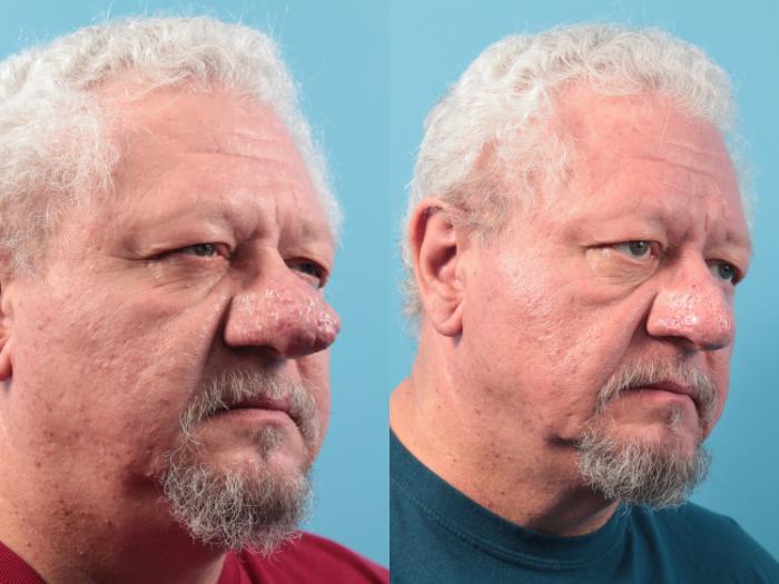 Before & After Rhinophyma Case 62 View #1 View in West Des Moines & Ames, IA