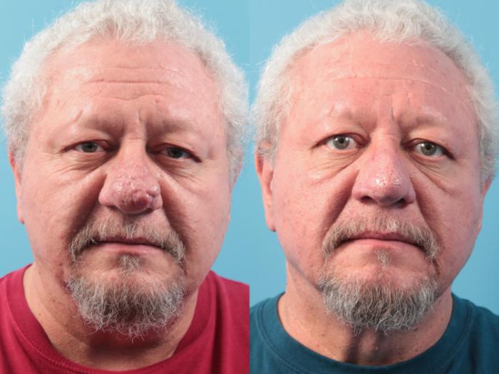 Before & After Rhinophyma Case 62 View #2 View in West Des Moines & Ames, IA