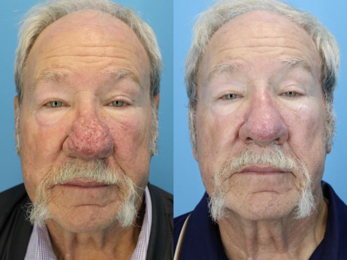 Before & After Rhinophyma Case 637 Front View in West Des Moines & Ames, IA