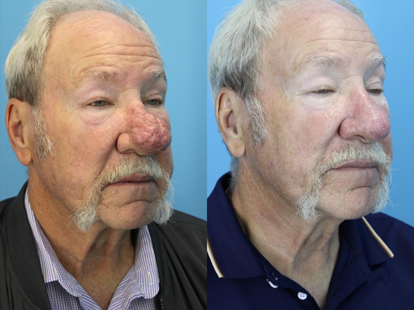 Before & After Rhinophyma Case 637 Left Side View in West Des Moines & Ames, IA