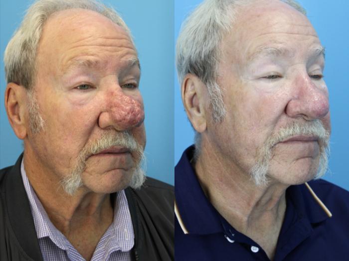 Before & After Rhinophyma Case 637 Left Side View in West Des Moines & Ames, IA