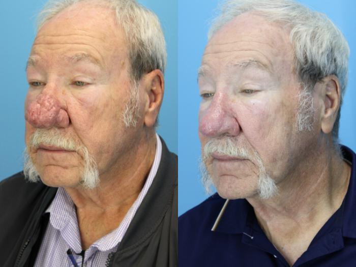 Before & After Rhinophyma Case 637 Oblique View in West Des Moines & Ames, IA