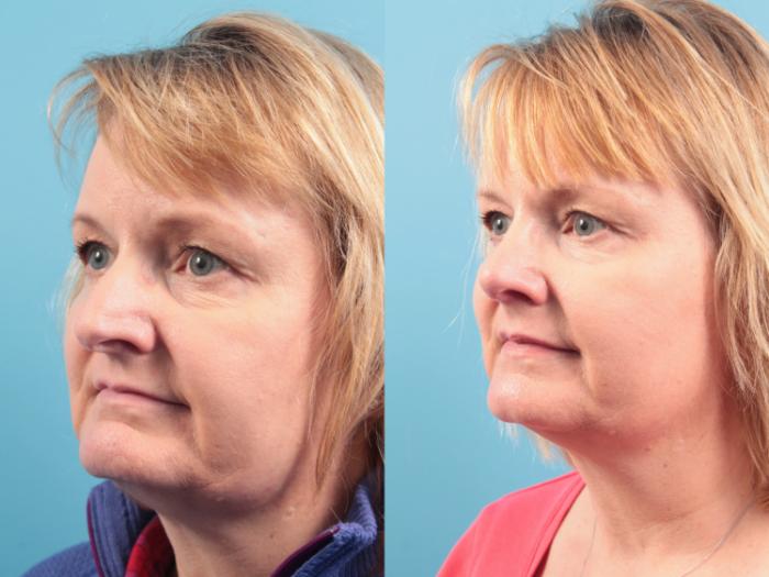 Before & After Rhinoplasty Case 105 Left Oblique View in West Des Moines & Ames, IA