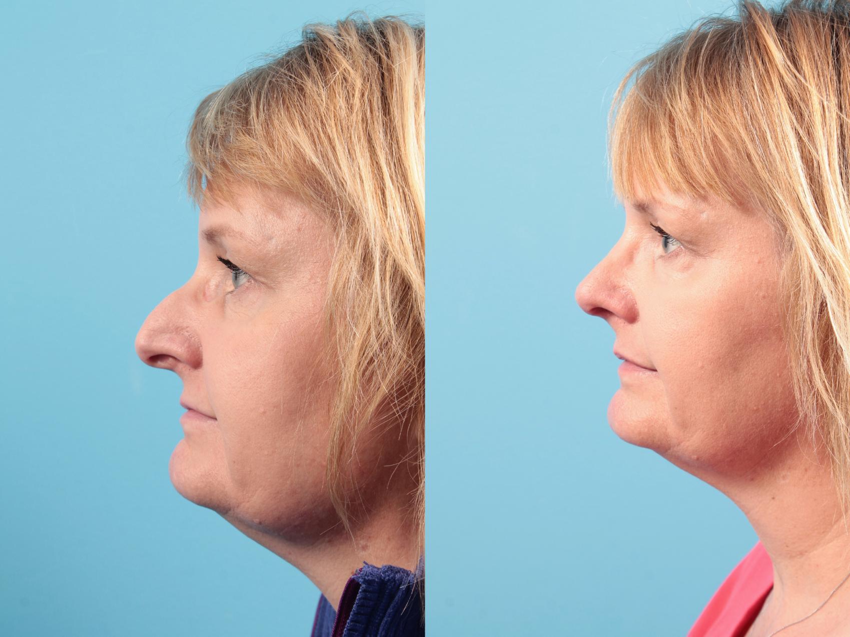 Before & After Rhinoplasty Case 105 Left Side View in West Des Moines & Ames, IA