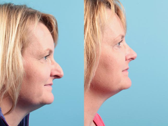 Before & After Rhinoplasty Case 105 Right Side View in West Des Moines & Ames, IA