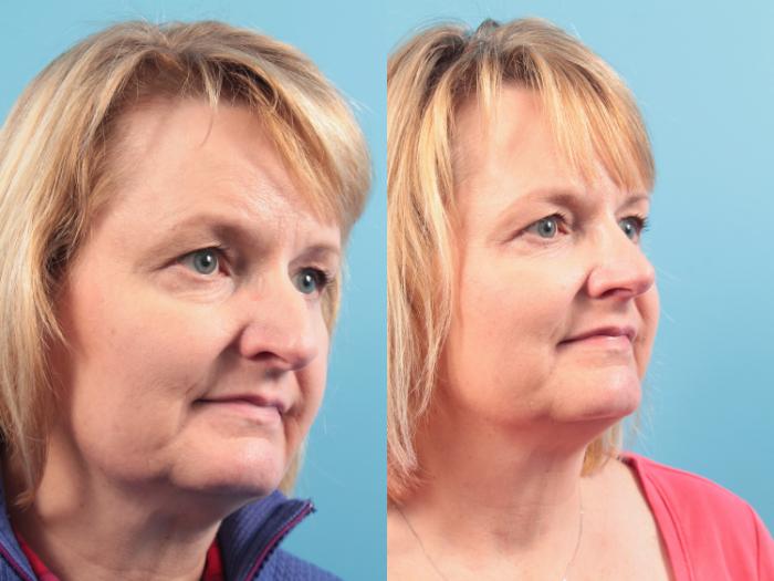 Before & After Rhinoplasty Case 105 View #4 View in West Des Moines & Ames, IA