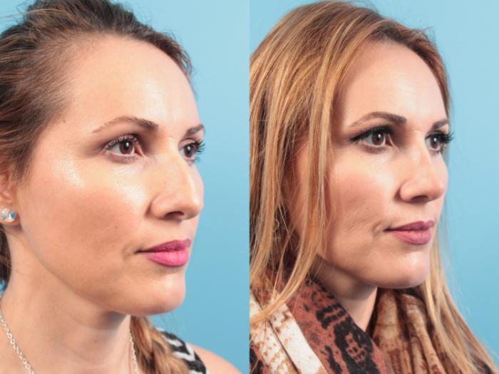 Before & After Rhinoplasty Case 108 Right Oblique View in West Des Moines & Ames, IA