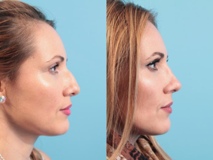 Before & After Rhinoplasty Case 108 Right Side View in West Des Moines & Ames, IA