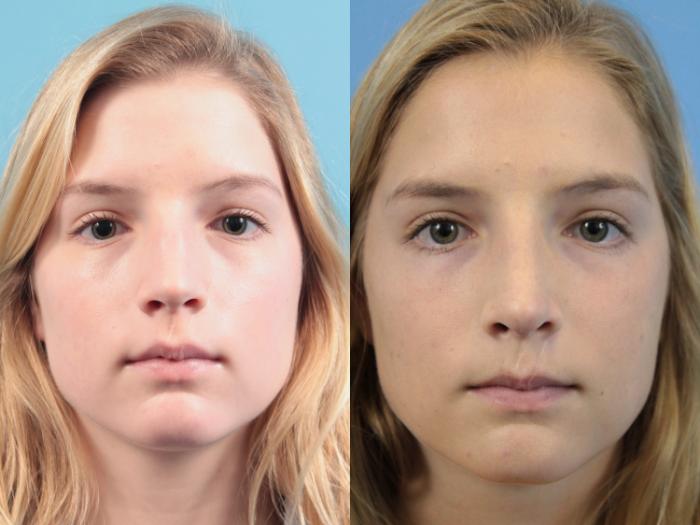 Before & After Rhinoplasty Case 116 Front View in West Des Moines & Ames, IA