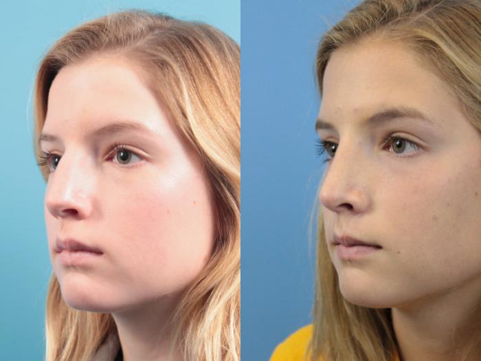 Before & After Rhinoplasty Case 116 Left Oblique View in West Des Moines & Ames, IA
