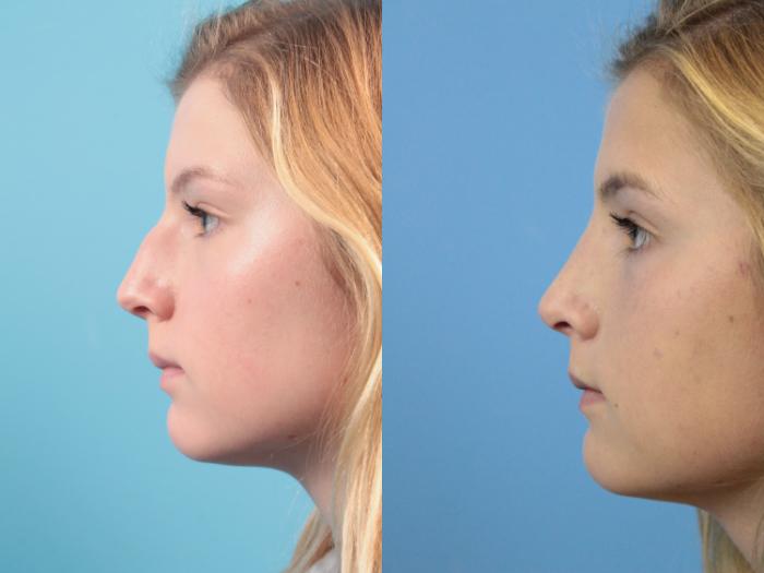 Before & After Rhinoplasty Case 116 Left Side View in West Des Moines & Ames, IA
