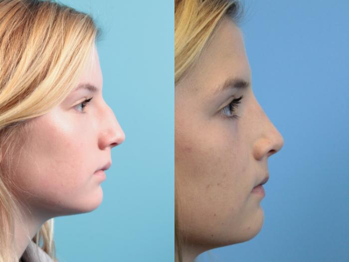Before & After Rhinoplasty Case 116 Right Side View in West Des Moines & Ames, IA