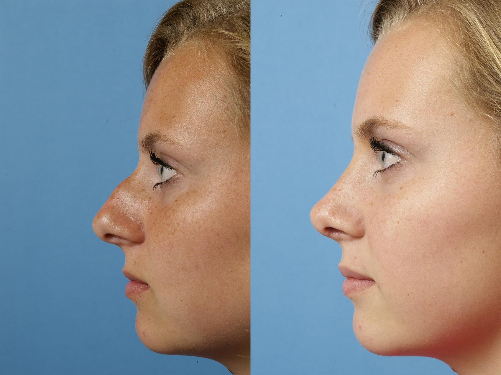 Before & After Rhinoplasty Case 125 Left Side View in West Des Moines & Ames, IA
