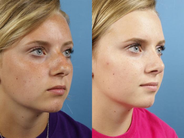Before & After Rhinoplasty Case 125 Right Oblique View in West Des Moines & Ames, IA