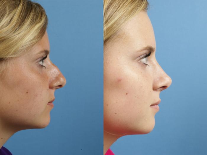 Before & After Rhinoplasty Case 125 Right Side View in West Des Moines & Ames, IA