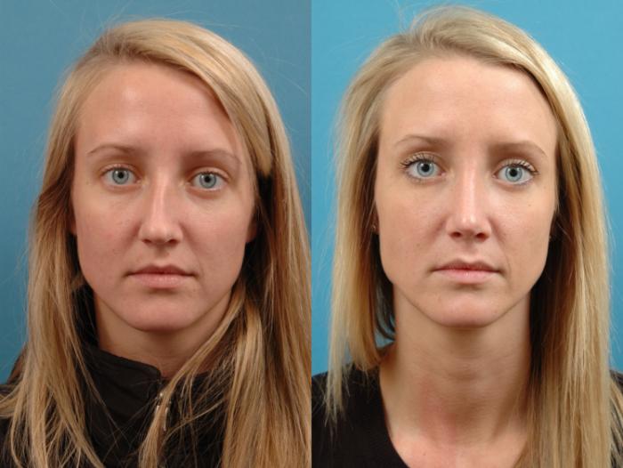 Before & After Rhinoplasty Case 126 Front View in West Des Moines & Ames, IA