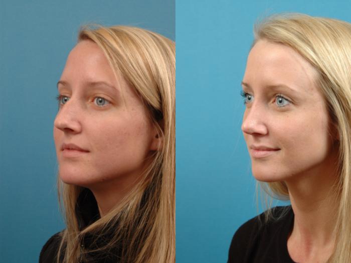 Before & After Rhinoplasty Case 126 Left Oblique View in West Des Moines & Ames, IA
