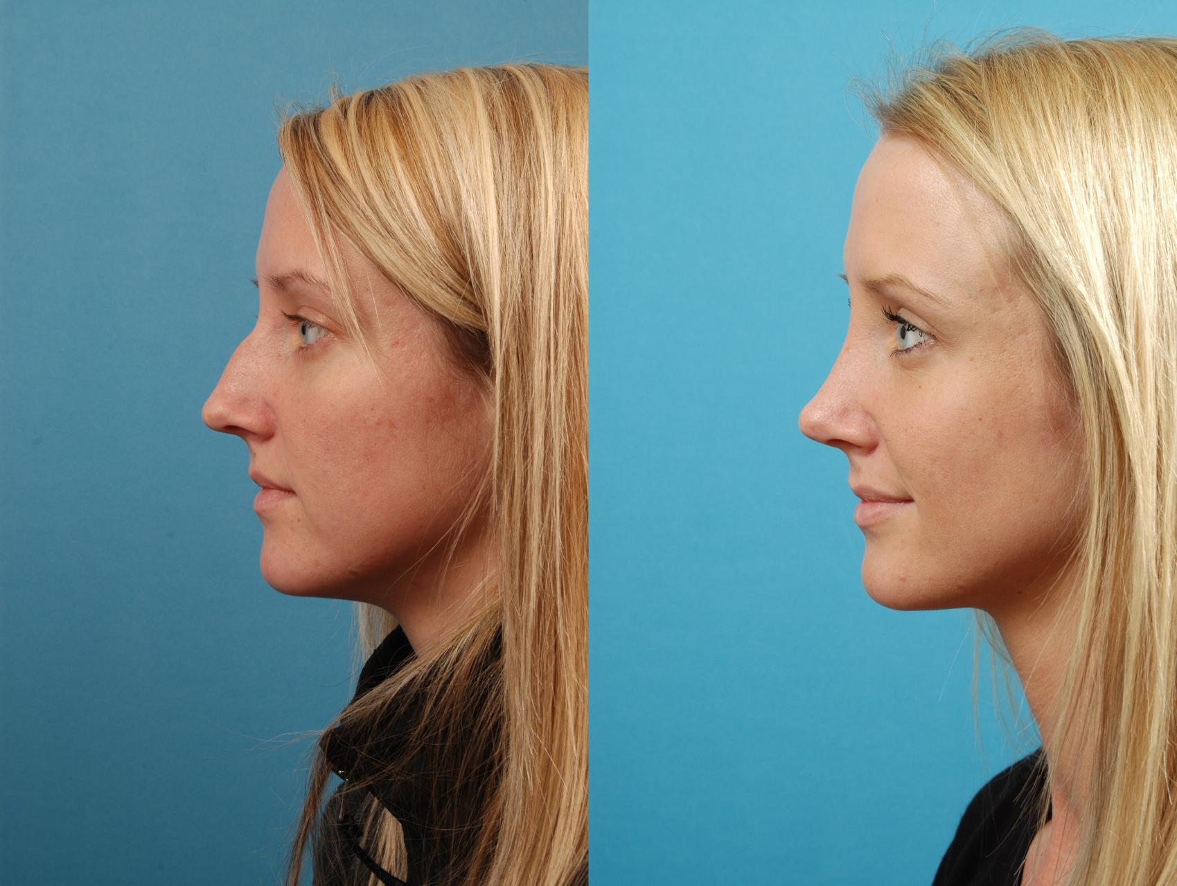Before & After Rhinoplasty Case 126 Left Side View in West Des Moines & Ames, IA