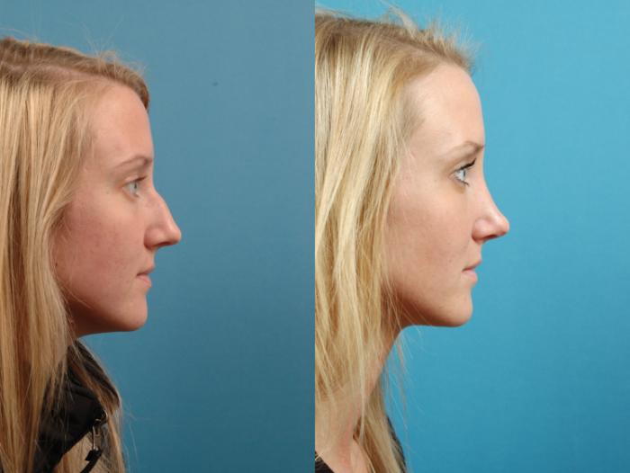 Before & After Rhinoplasty Case 126 Right Side View in West Des Moines & Ames, IA