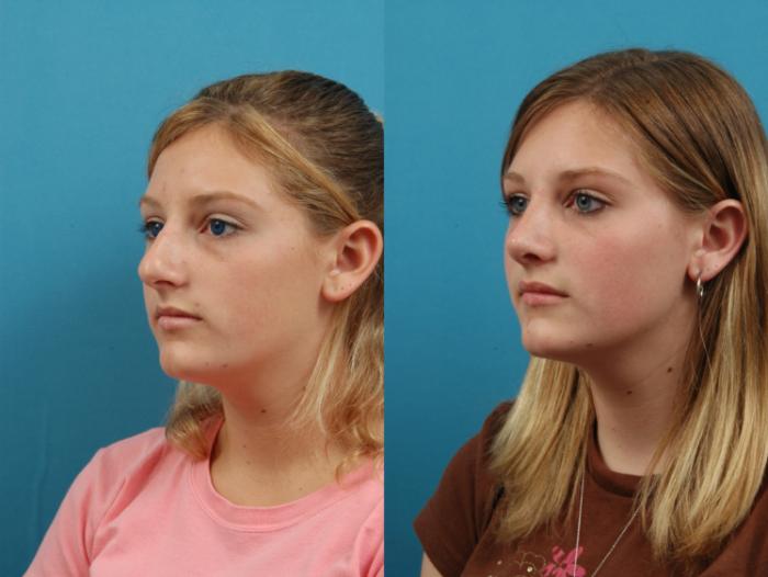 Before & After Rhinoplasty Case 127 Left Oblique View in West Des Moines & Ames, IA
