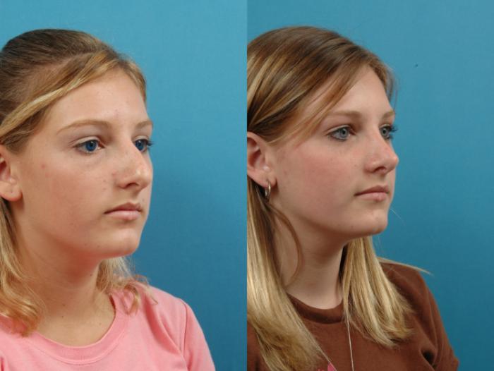 Before & After Rhinoplasty Case 127 Right Oblique View in West Des Moines & Ames, IA