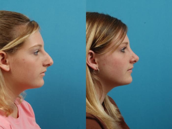 Before & After Rhinoplasty Case 127 Right Side View in West Des Moines & Ames, IA