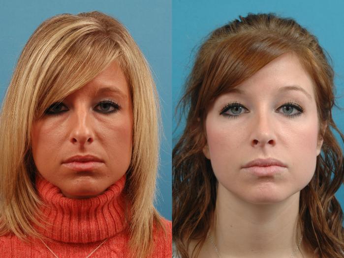 Before & After Rhinoplasty Case 129 Front View in West Des Moines & Ames, IA