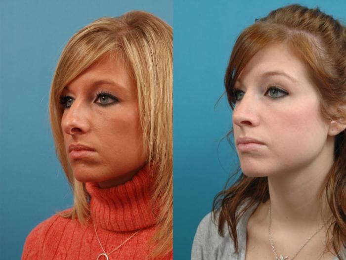 Before & After Rhinoplasty Case 129 Left Oblique View in West Des Moines & Ames, IA