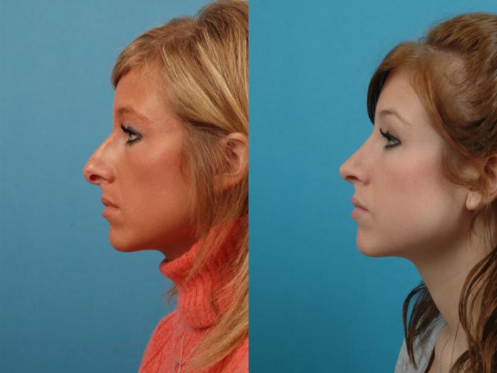 Before & After Rhinoplasty Case 129 Left Side View in West Des Moines & Ames, IA